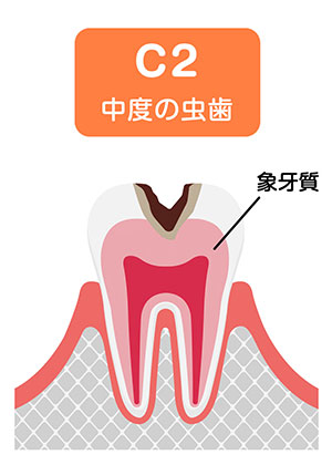 歯の内部まで進行した虫歯