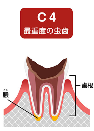 歯の根っこだけになるまで進行したう蝕